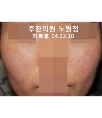 치료 후