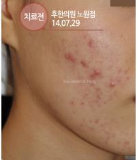 치료 전