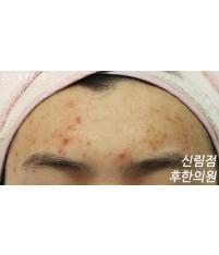 치료 전