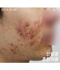 치료 전