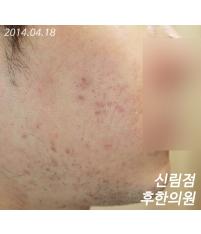 치료 후