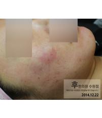 치료 후