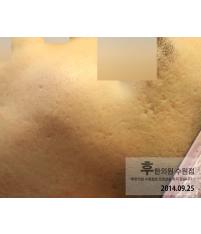 치료 전