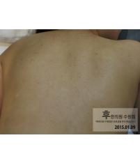 치료 후