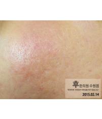 치료 후
