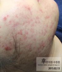 치료 후