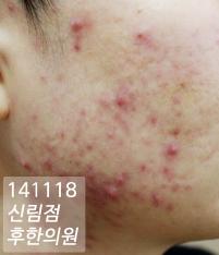 치료 전
