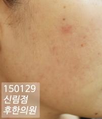 치료 후