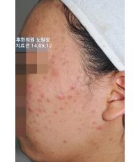 치료 전