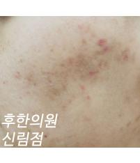 치료 전