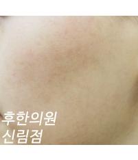 치료 후