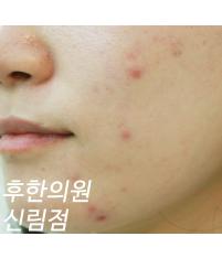 치료 전
