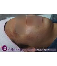 치료 전
