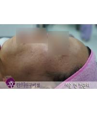 치료 전