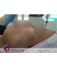 치료 후