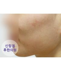 치료 후