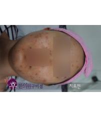 치료 전