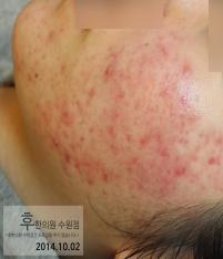 치료 전