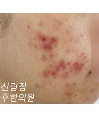 치료 전