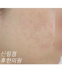 치료 후