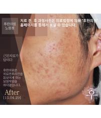 치료 후