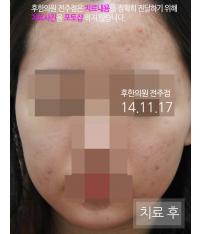 치료 후