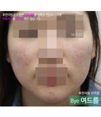 치료 후