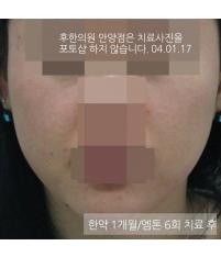 치료 후