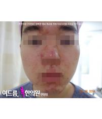 치료 전
