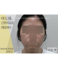 치료 후