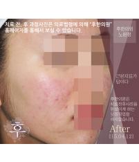 치료 후