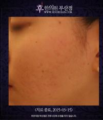 치료 후