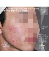 치료 후