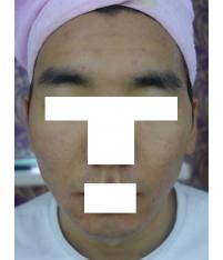 치료 후