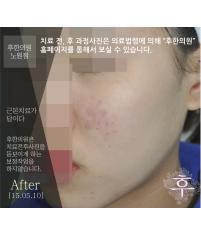 치료 후