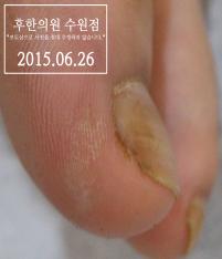 치료 후