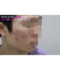 치료 전
