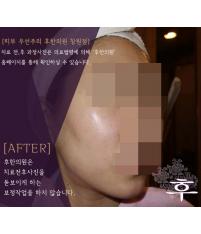 치료 후