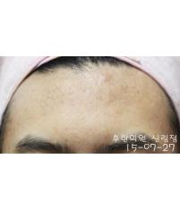 치료 후