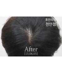 치료 후