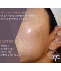 치료 후