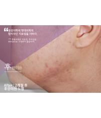 치료 후