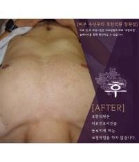 치료 후