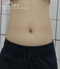 치료 후