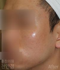 치료 후