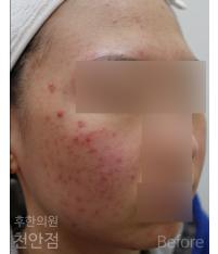 치료 전