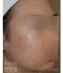 치료 후