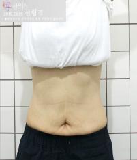 치료 후