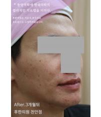 치료 후