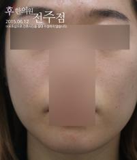 치료 후